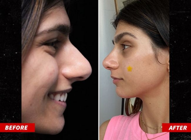 Mia Khalifa nose job