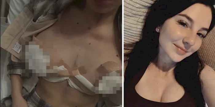 Big boob models getting boob reductions