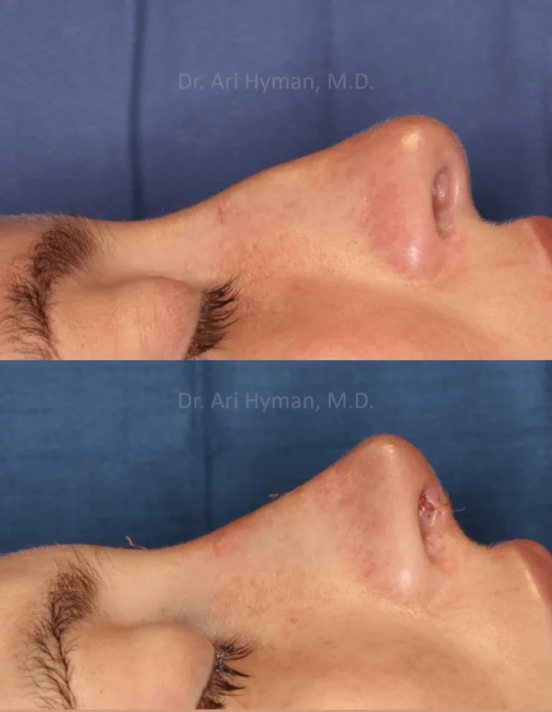 Side-by-side before and after images of a persons profile showing changes to the nose, likely from a rhinoplasty procedure. The skin tone is light and the images have a blue background.